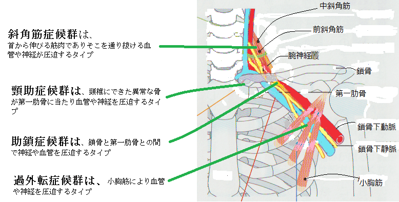 胸郭出口3.png